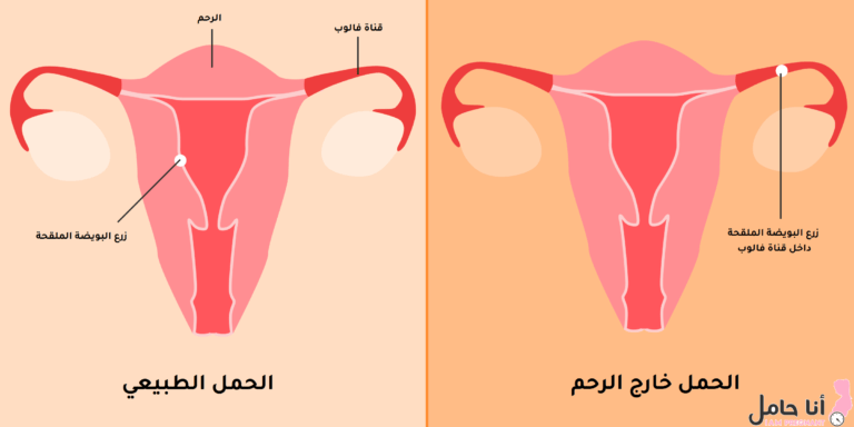 علاج الحمل خارج الرحم